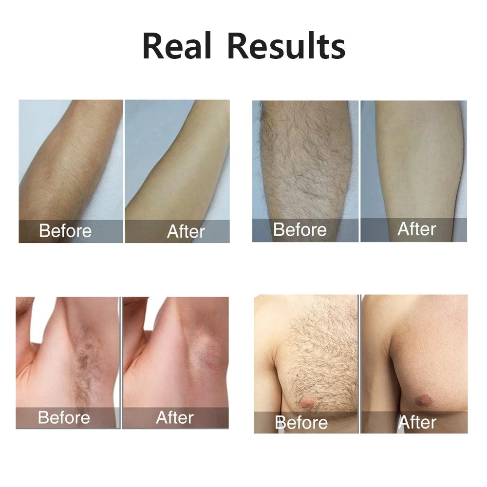IPL Laser Hair Removal Device 990,000 Flashes Painless Permanent Epilator for Women Body & Face